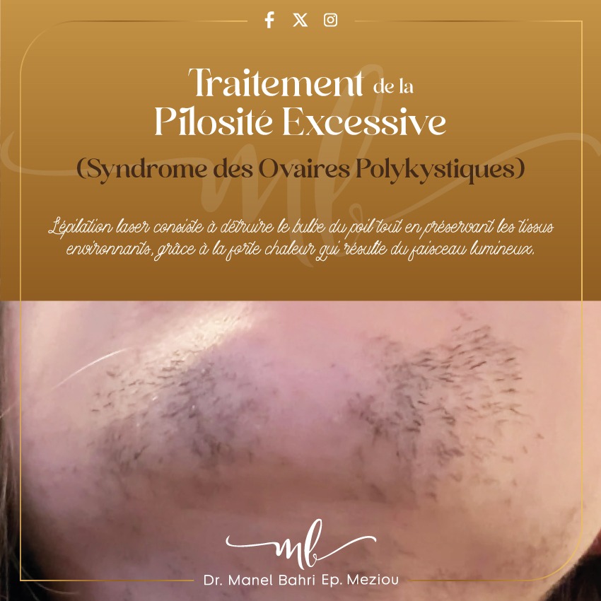Traitement de pilosité excessive