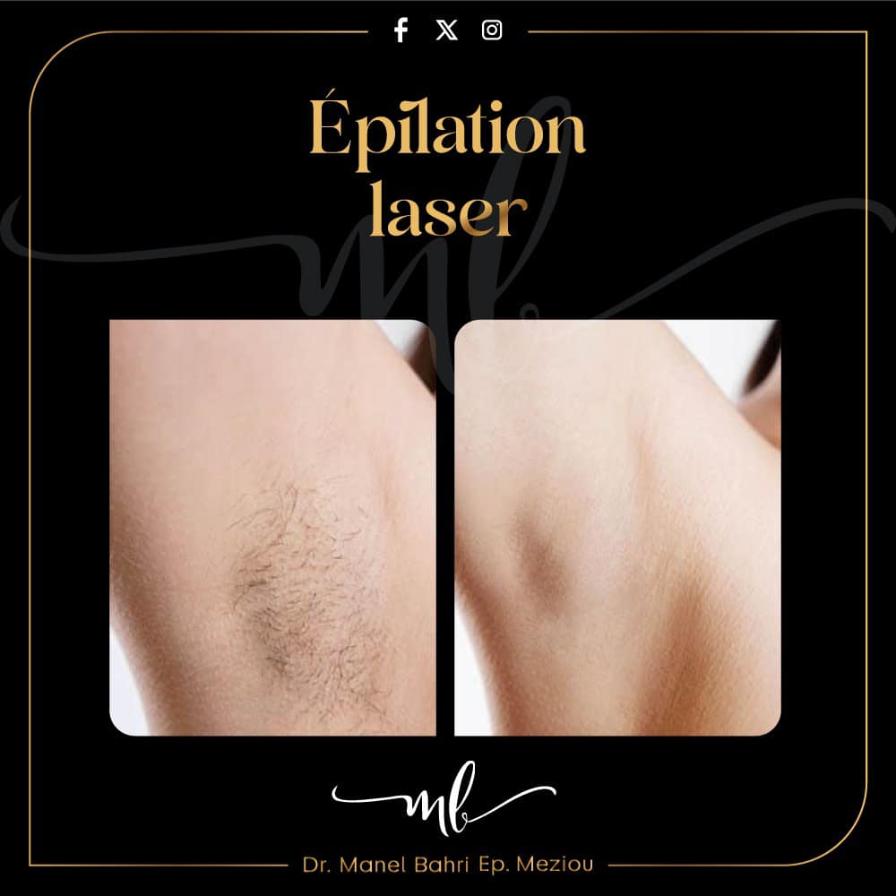 Epilation laser