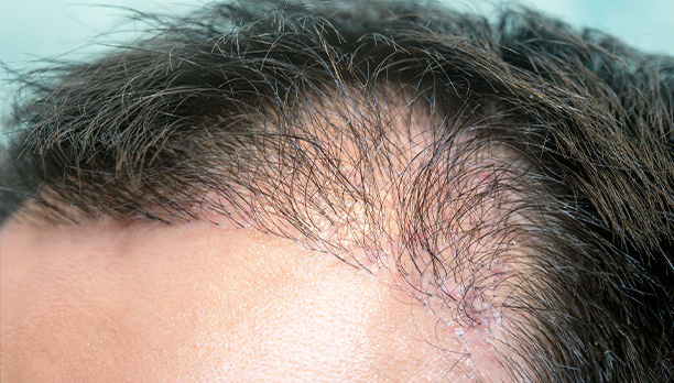 Greffe de cheveux en Tunisie : tout ce qu’il faut savoir