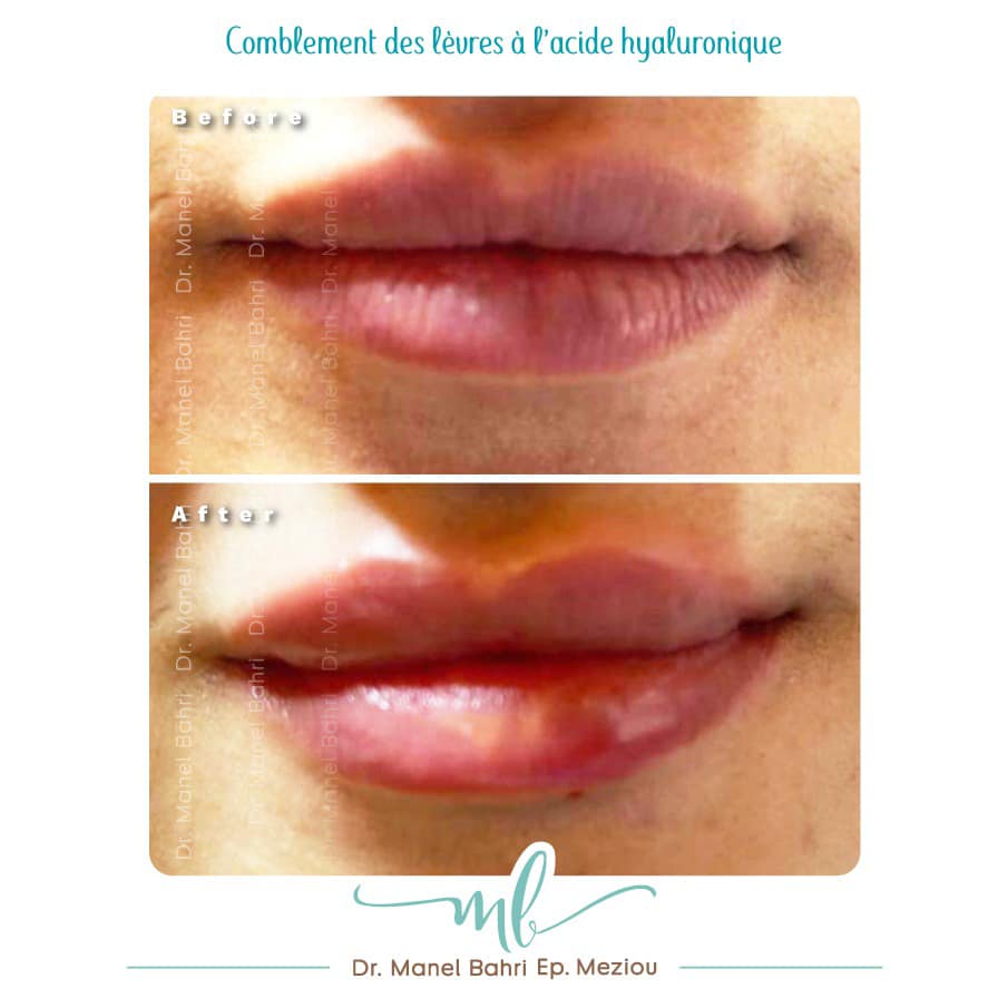 comblement de lèvres à l'acide hyaluronique