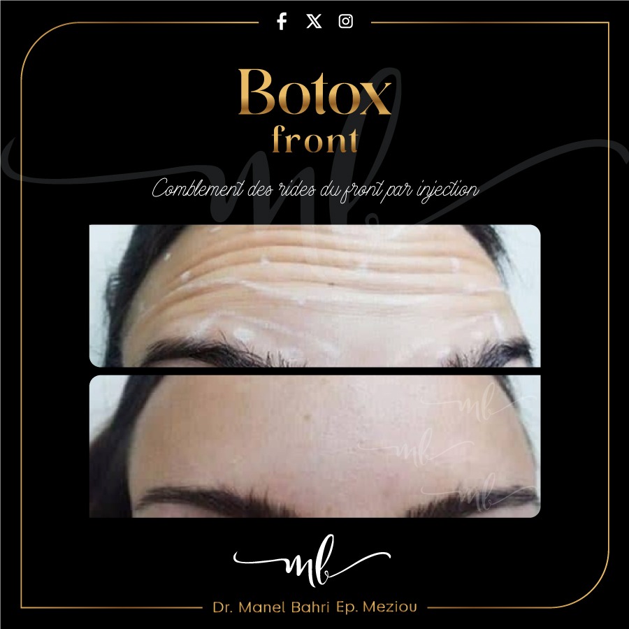 Botox Front