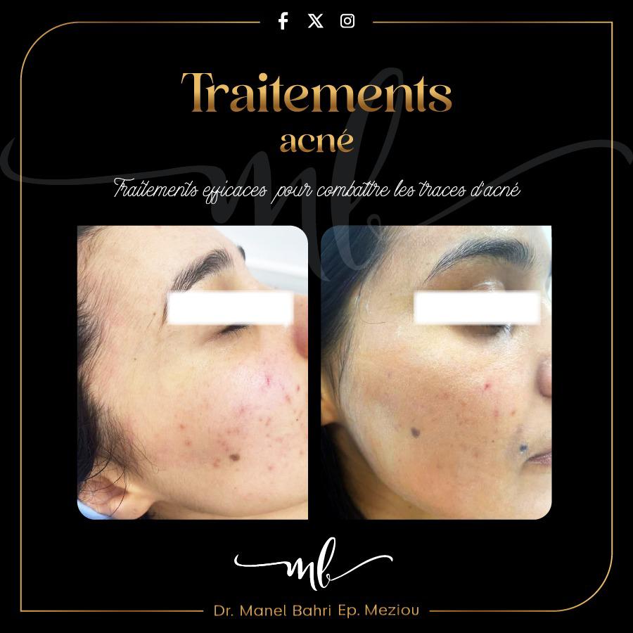 Traitements acnés