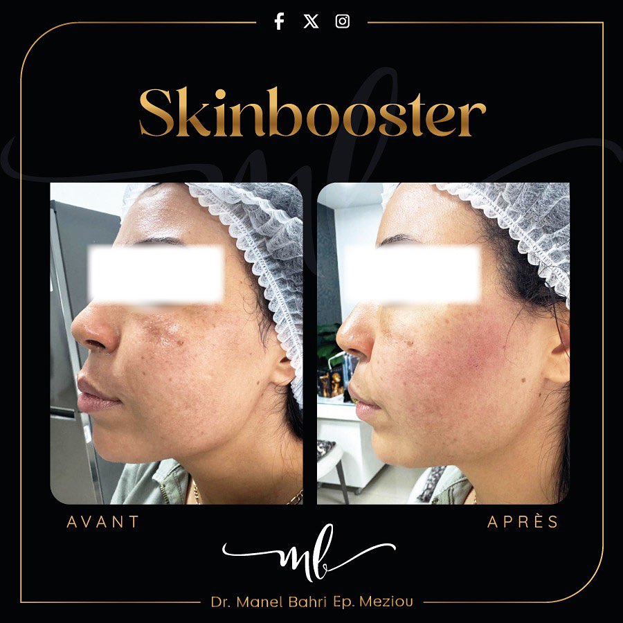 Booster de peau
